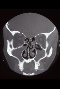 Acute/Subacute Rhinosinusitis