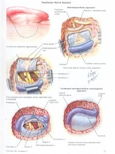 Vestibular Nerve Section